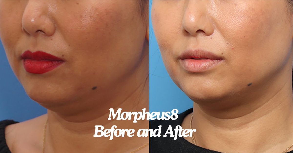 Morpheus8 Before and After